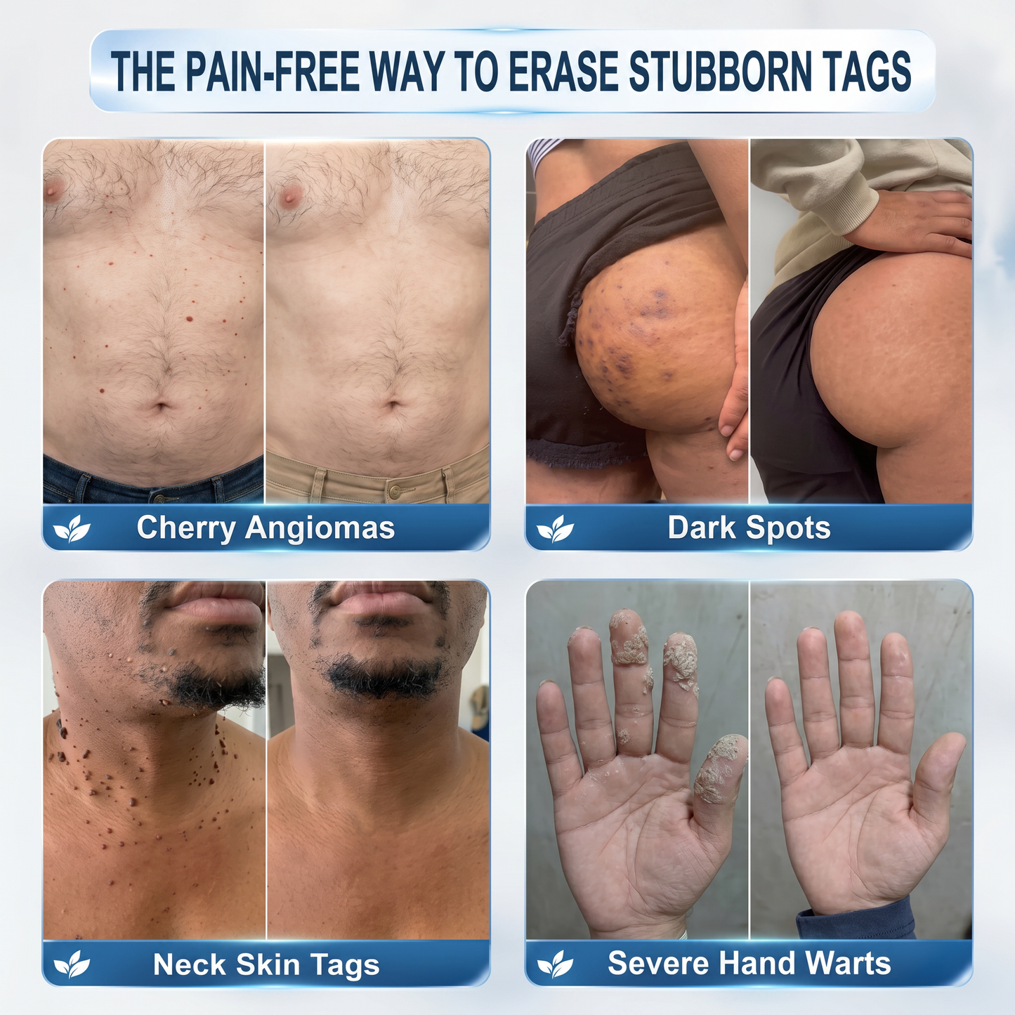Authorized Brand Store✨|🌥️𝐕𝐢𝐭𝐚𝐥𝐢𝐬𝐲𝐬® 7-𝐷𝑎𝑦 𝗧𝐚𝐠 & 𝗦𝗽𝐨𝐭 𝐄𝐫𝒂𝒔𝒆𝒓(Zero Pain, Zero 𝐒𝐜𝐚𝒓𝒔 Rollerball)💛